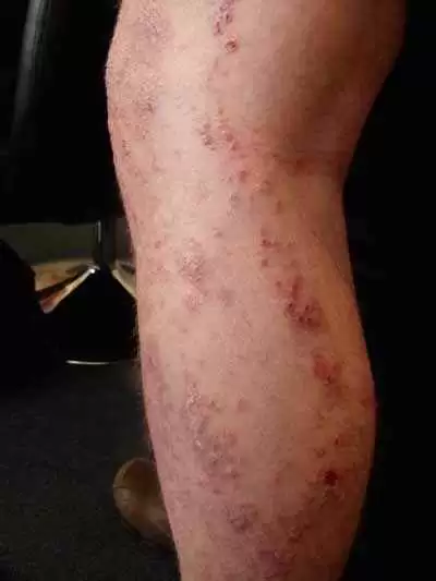 Dermatitis Herpetiformis Dermatitis Herpetiformis