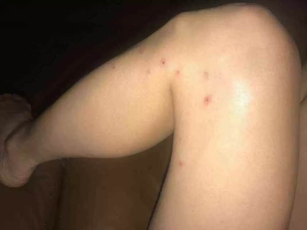 DH Rash from Roundup (Glyphosate)?