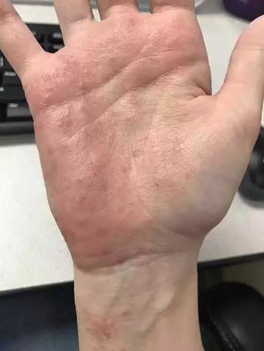 rash-on-hands-celiac