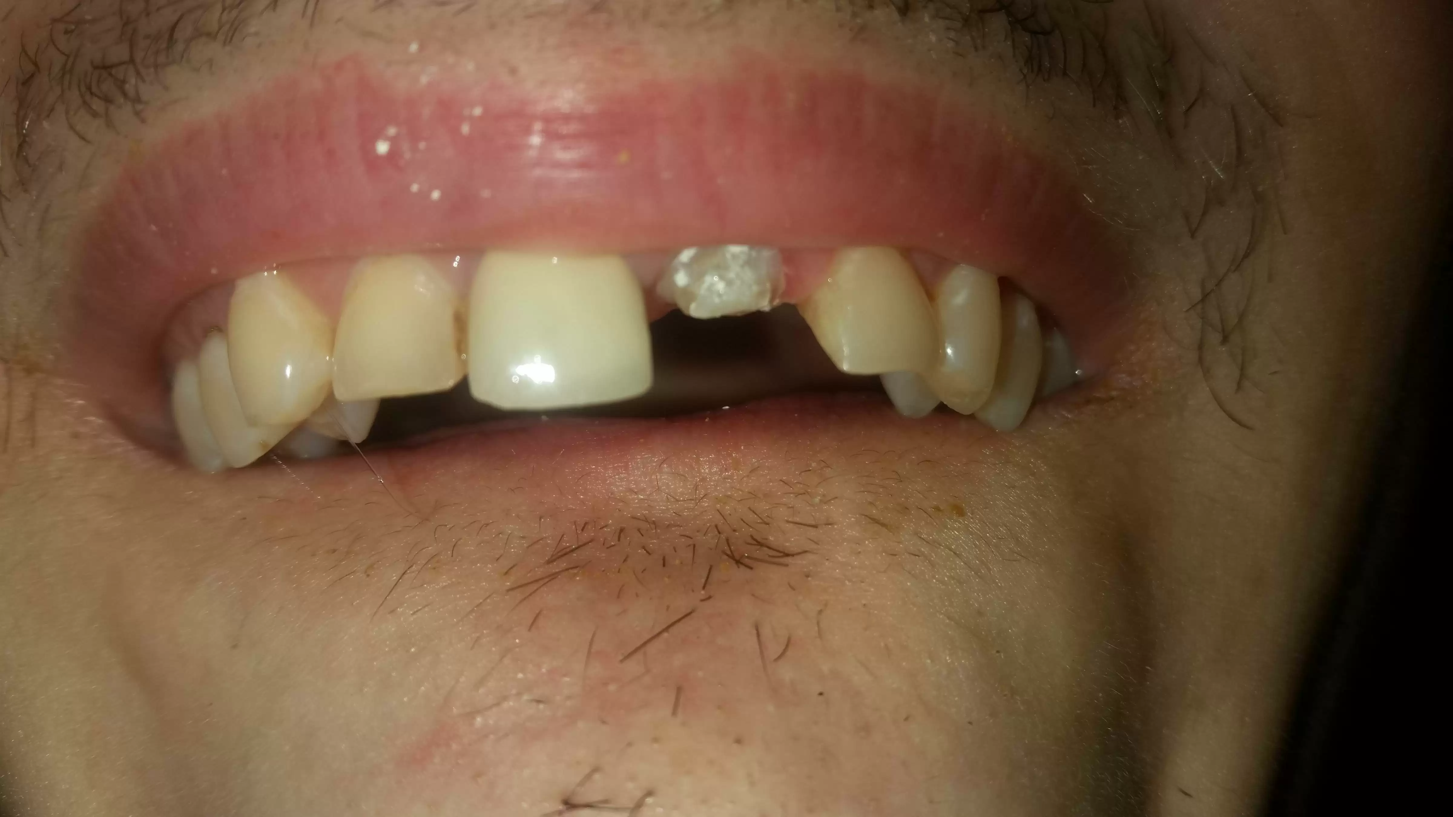 Breaking Teeth