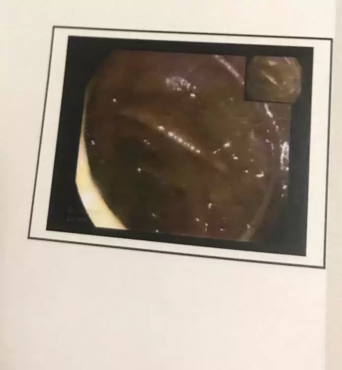 Endoscopy + colonoscopy picture